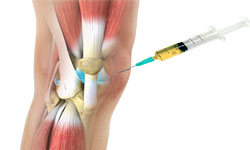 Your Body's Healing Power Platelet Rich Plasma Therapy: One of the most exciting advancements in Orthobiologics  REDUCE PAIN. DELAY SURGERY. GET BACK TO LIVING.